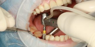 proteze dentare in sectorul 2